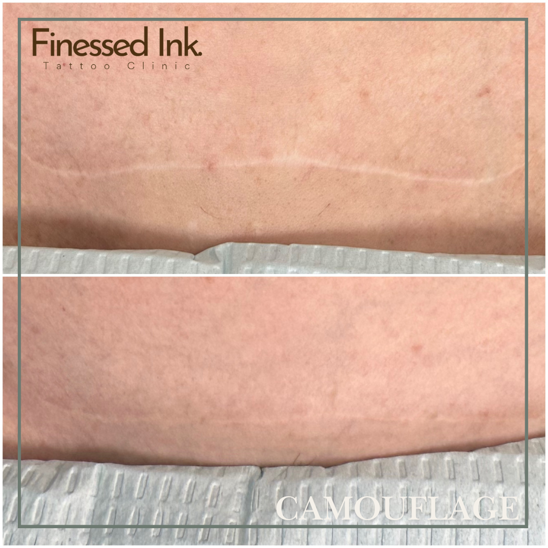 scar camouflage tattoo