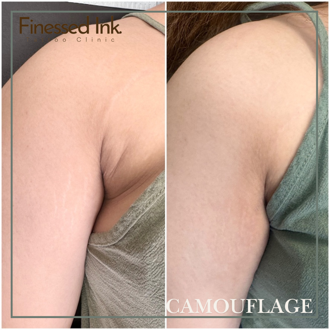 Stretch mark camouflage.png