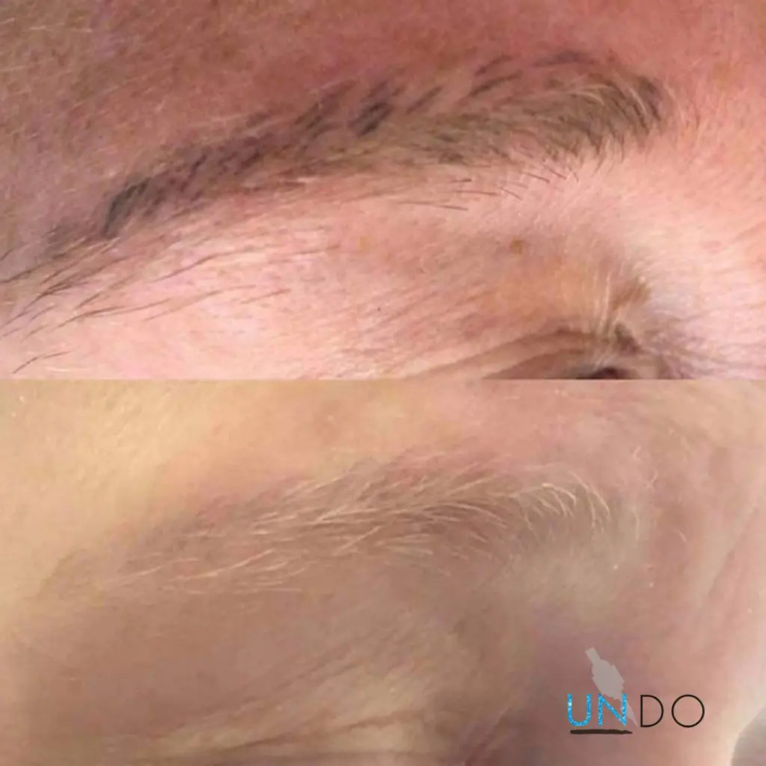 Microblading tattoo removal.png