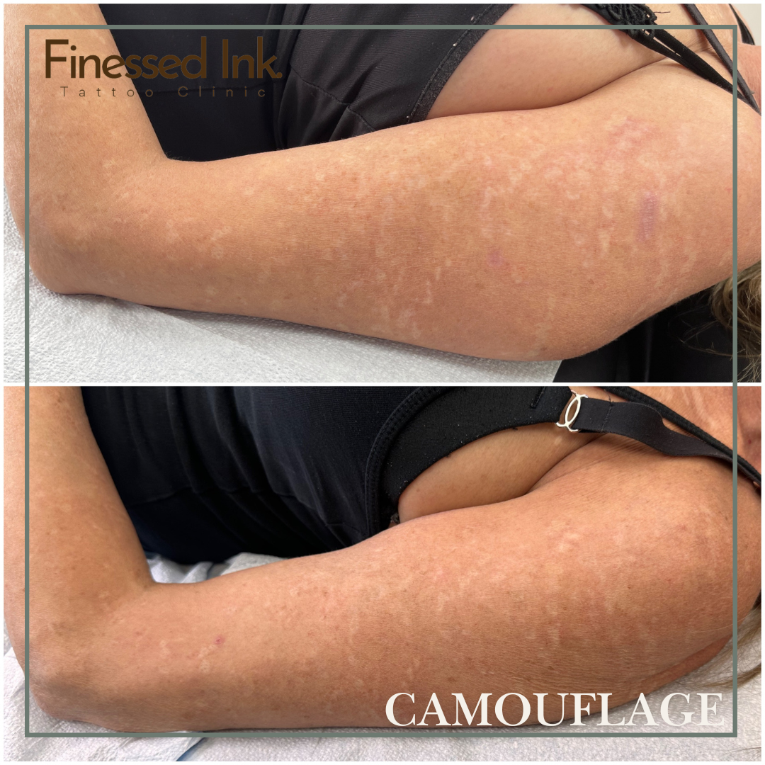 scar camouflage tattoo