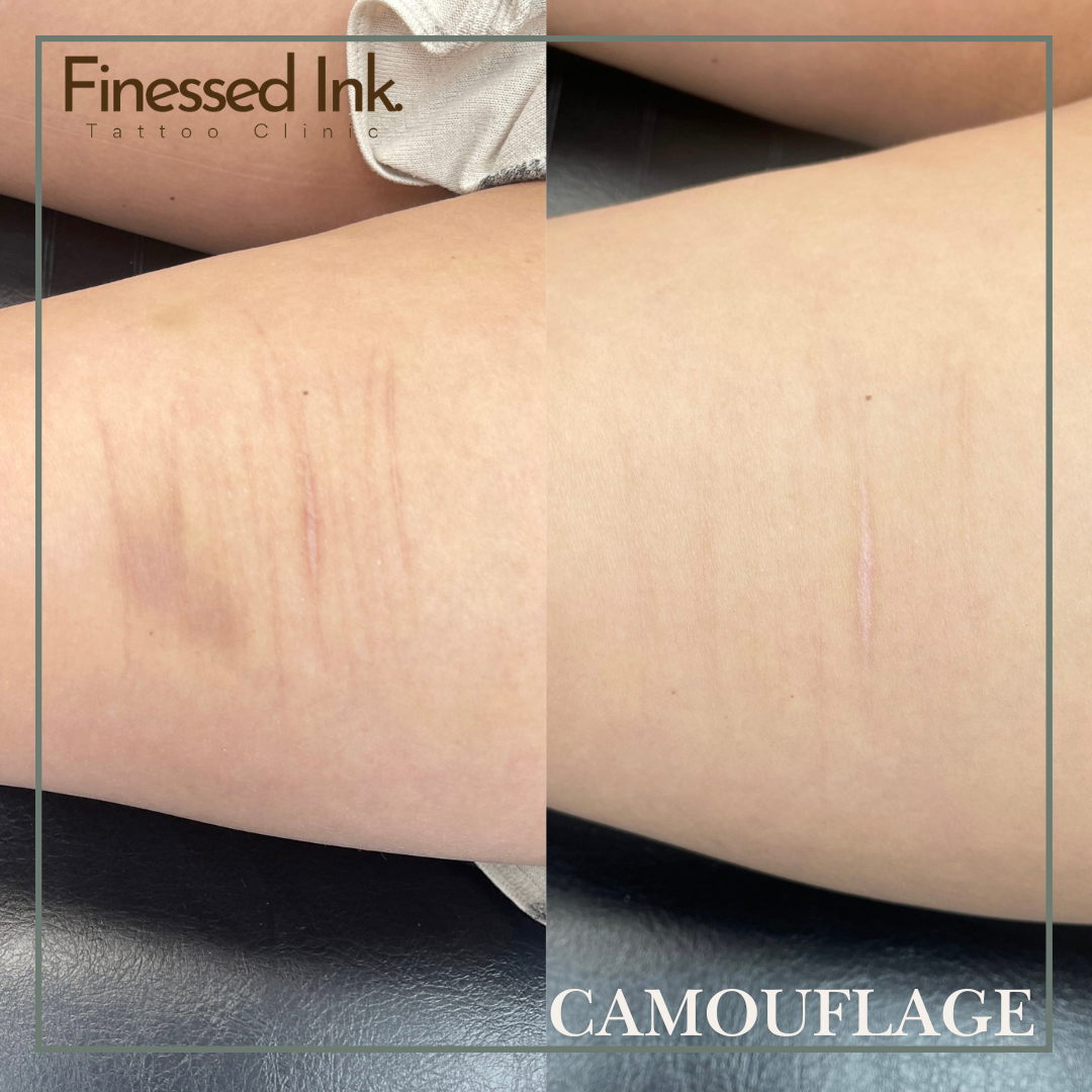 scar camouflage tattoo