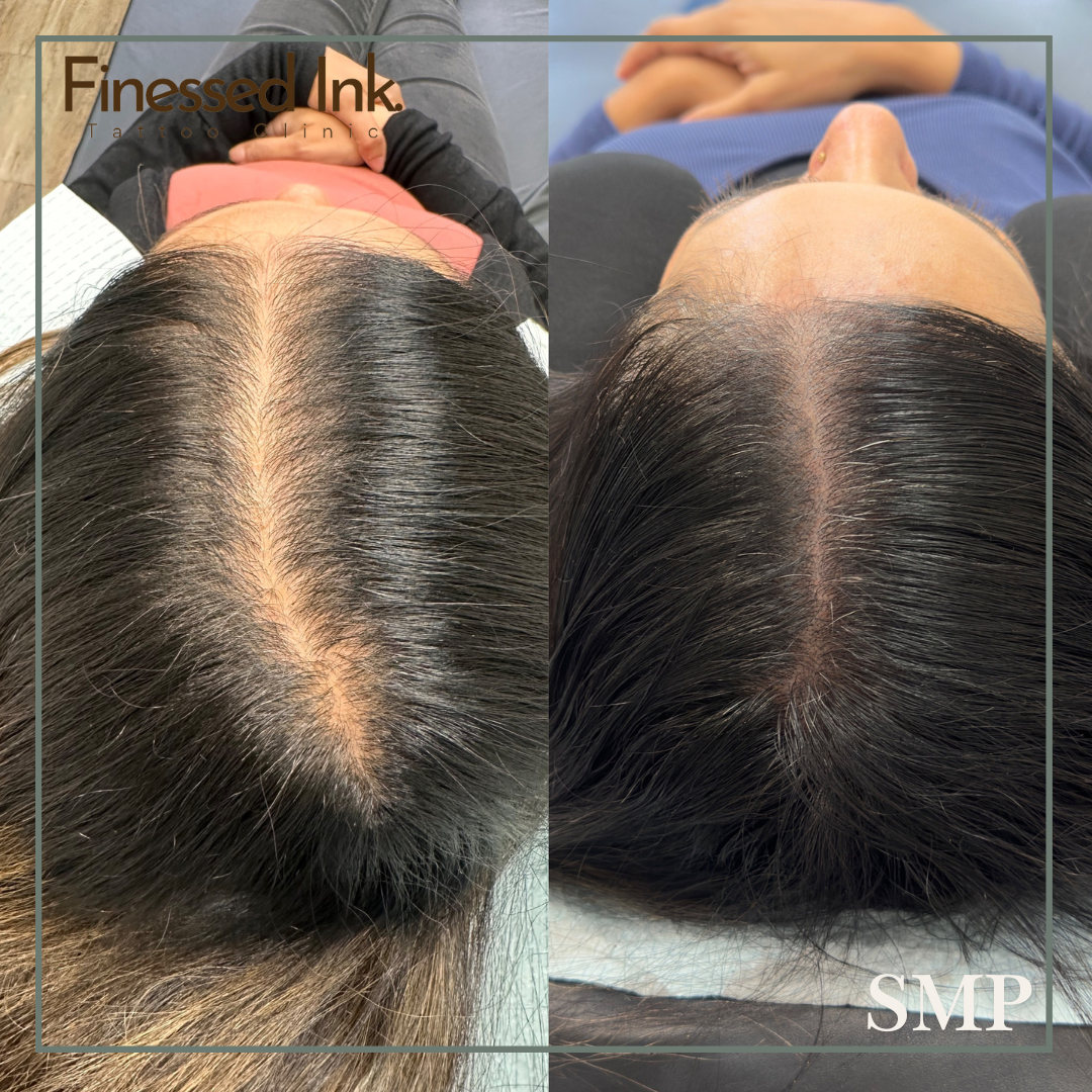 Comparison of a person's scalp before and after hair treatment, showing improved hair density and coverage.