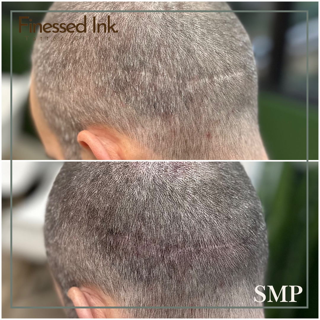 SMP Tattoo Before and After Hair Transplant Scar.png