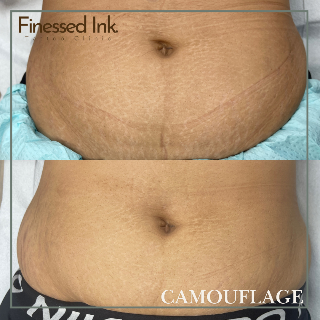 Stretch mark Camouflage tattoo.png