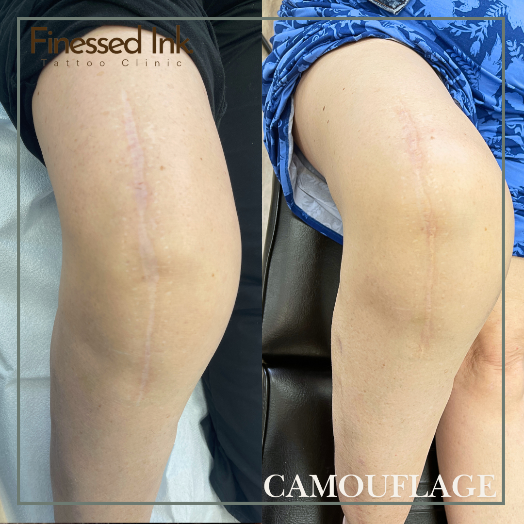 Knee scar camouflage tattoo