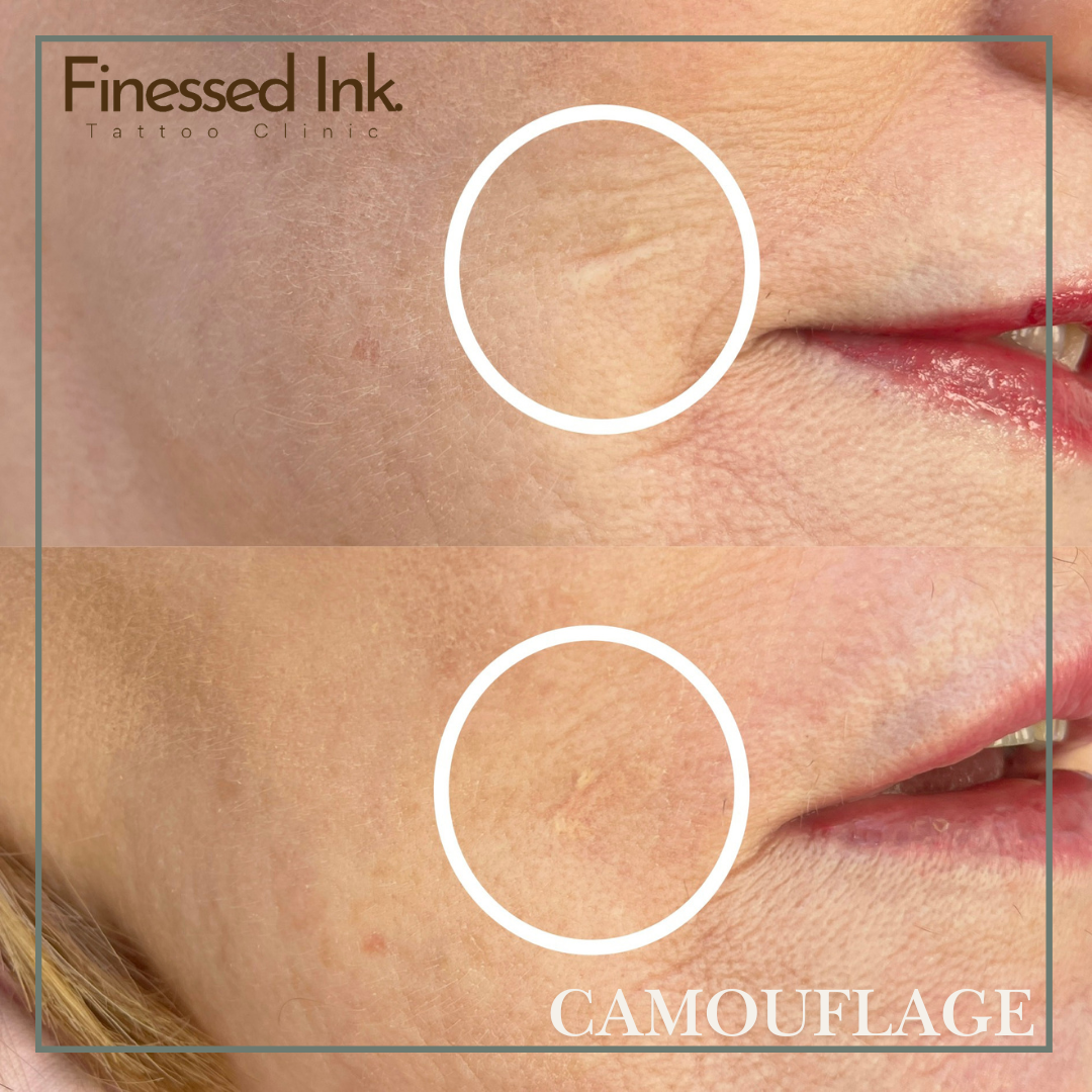 Face scar camouflage tattoo