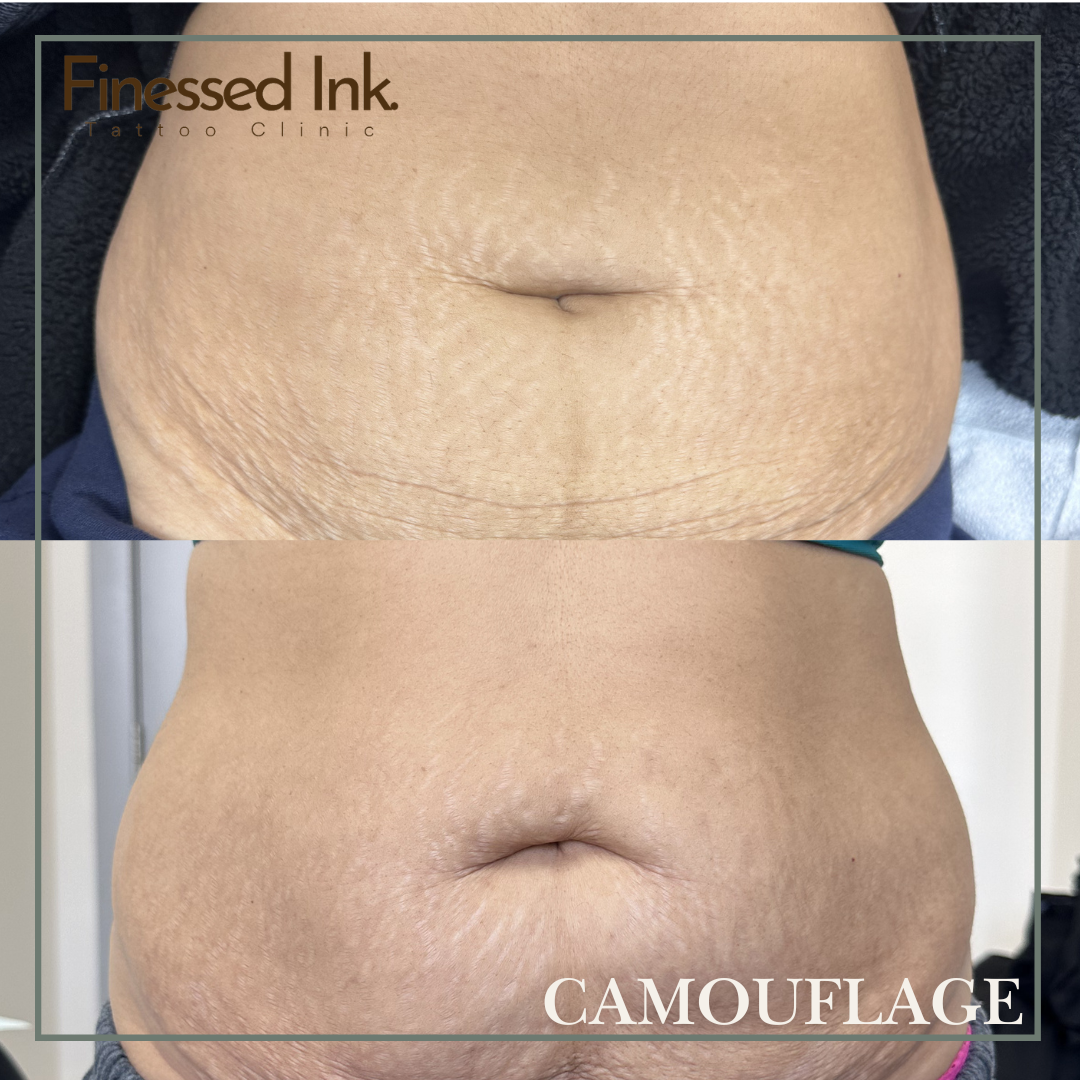 Stretch mark on stomach.png