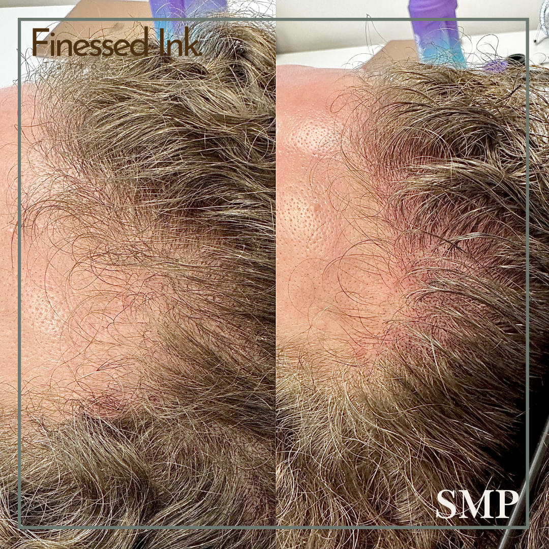 SMP Tattoo Before and After Hair line blonde.png