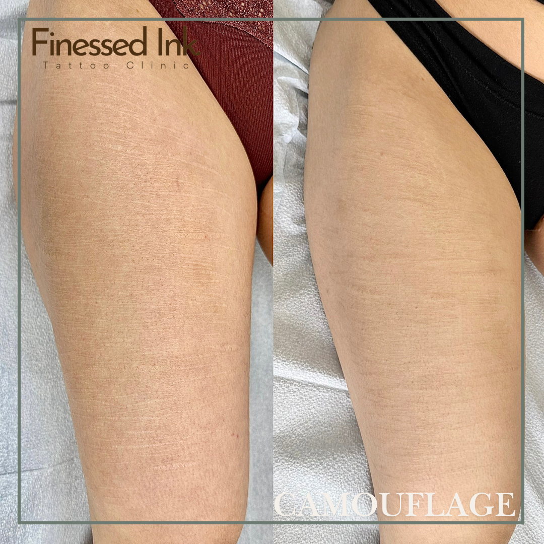 scar camouflage tattoo