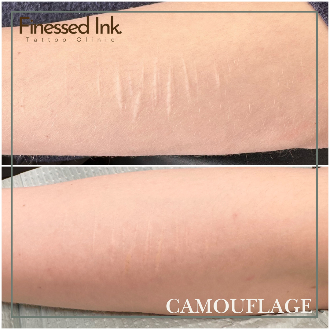 scar camouflage tattoo