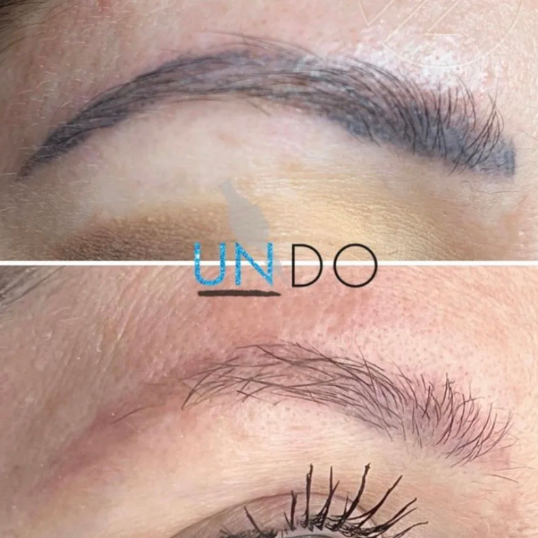 Eyebrow Microblading tattoo removal.png