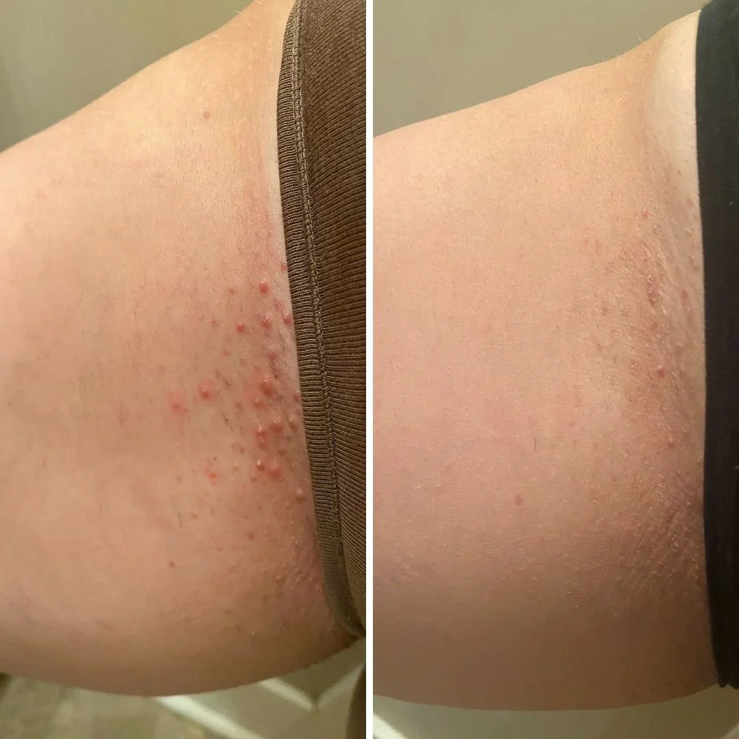Ingrown-hair-oil-before-and-after-photo.webp