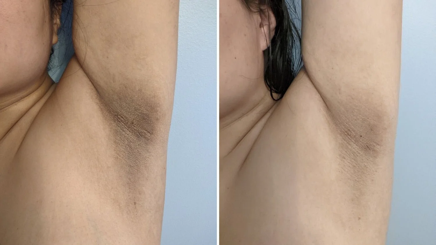 Acanthosis_Nigricans_darkness_in_underarms_before_and_after_1500x.jpg