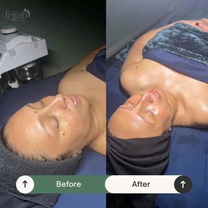 Discover our Nano Infusion Facial &mdash; a 50-minute treatment that goes beyond the surface. This advanced facial uses a customized blend of powders and actives infused deep into the dermis with a nano pen to target your unique skin concerns. Finish