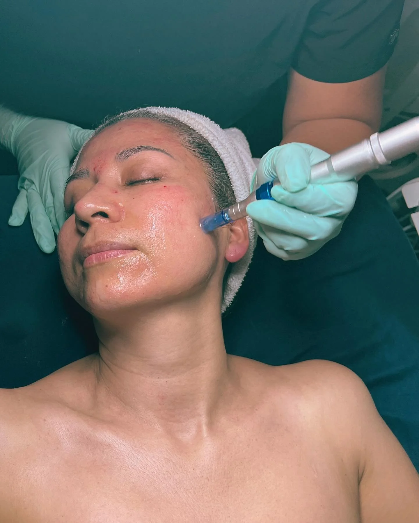 Now is the time to make a skinvestment to smooth, even, youthful skin you&rsquo;re confident in! This exclusive 4 session microneedling series is designed to refine your complexion from within &mdash; and this amazing offer is ONLY available for Blac