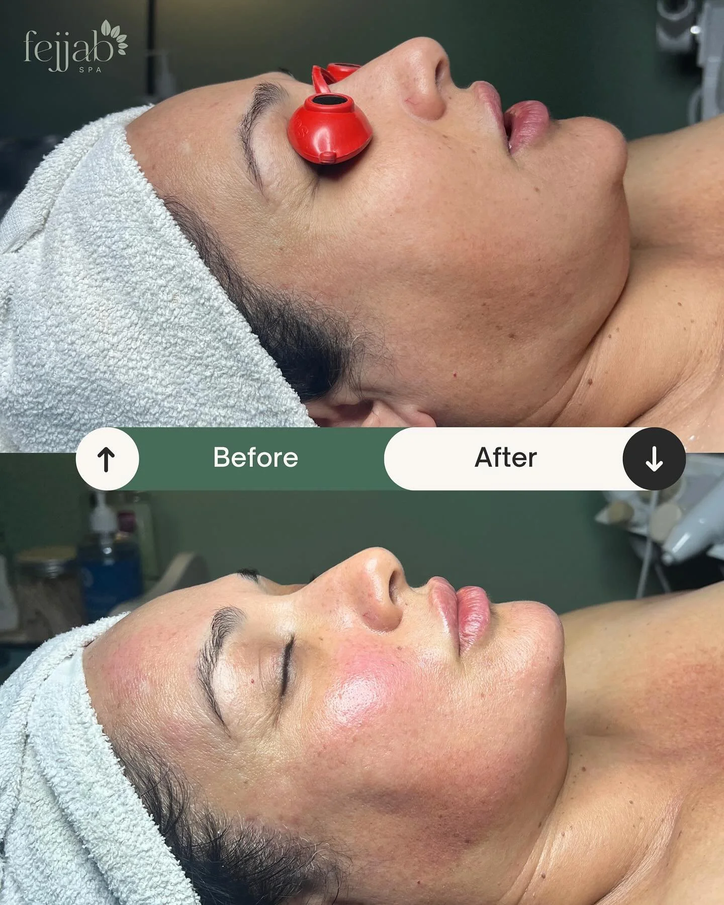 Our client came in with dull, dehydrated skin &mdash; and left with visibly brighter, smoother, more radiant skin after our Stem Cell Therapy Plus+ treatment. ✨

This 80-minute treatment includes:
&bull; Steam
&bull; Cleanse
&bull; Exfoliation
&bull;