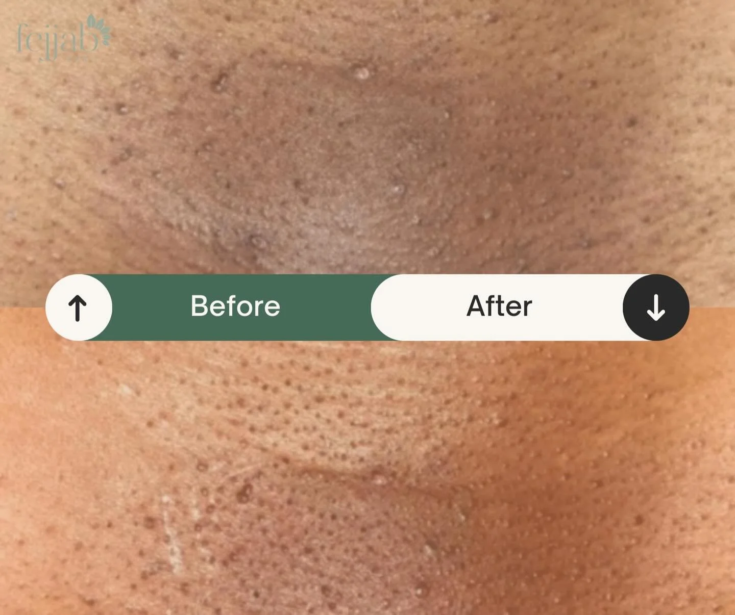 Our Intimate Brightening Treatment is now available as a limited-time offer 💎

Book 2 sessions and receive 1 FREE &mdash; exclusively for women.

This treatment uses gentle LED light therapy to support a more even, radiant appearance in delicate are