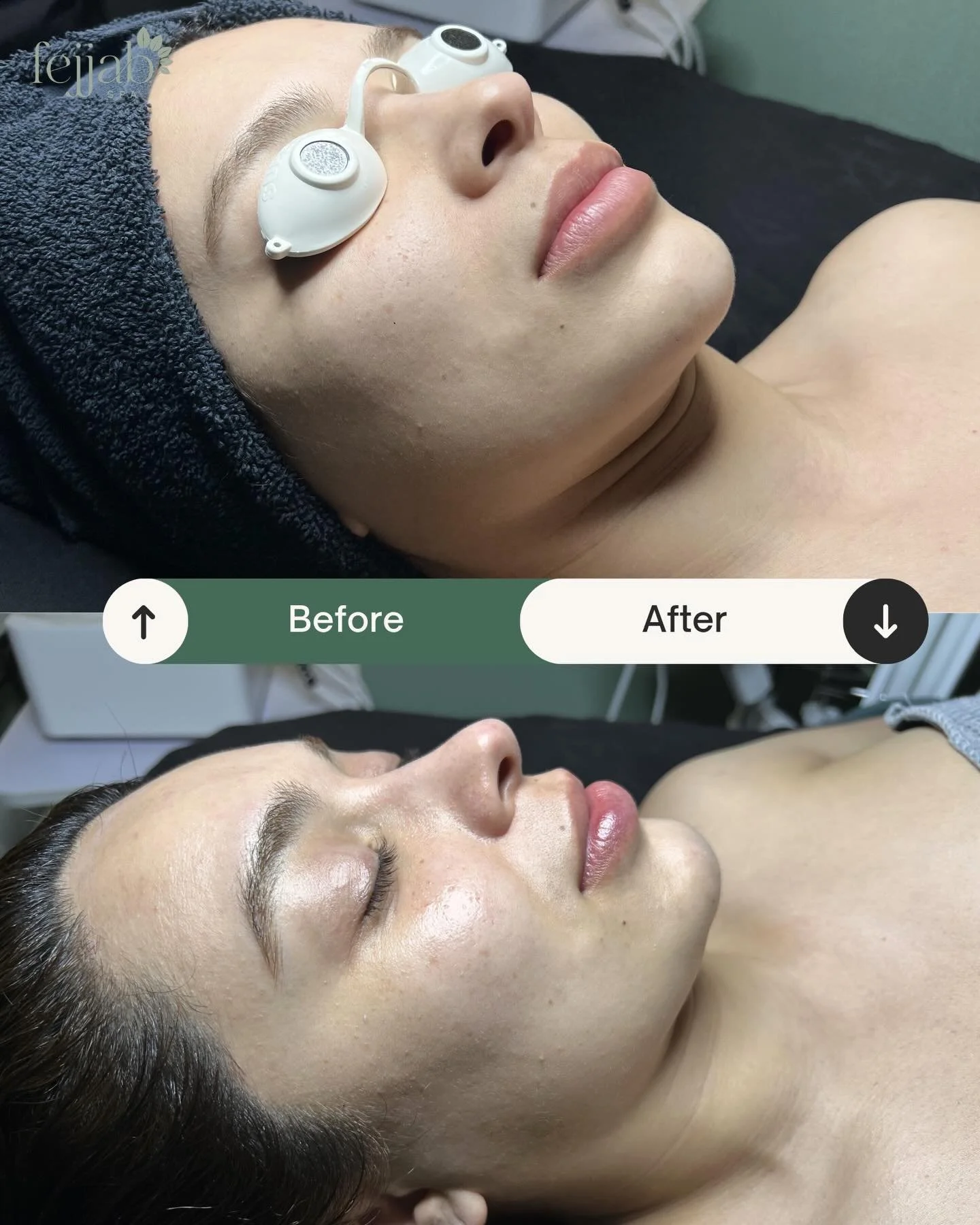Results after a Classic European Facial + non invasive mesotherapy + customized enzyme ✨

Brighter, smoother, and deeply refreshed skin.

Not sure where to start? We offer personalized skin analysis to guide you toward the right treatment for your sk