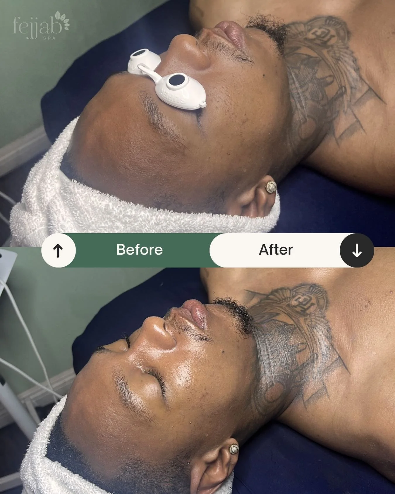 Before &rarr; After

Reduced congestion, smoother texture, and a noticeable glow after just one session ✨
Imagine the results with consistency.

Tap on the link in our bio to make your appointment ✅