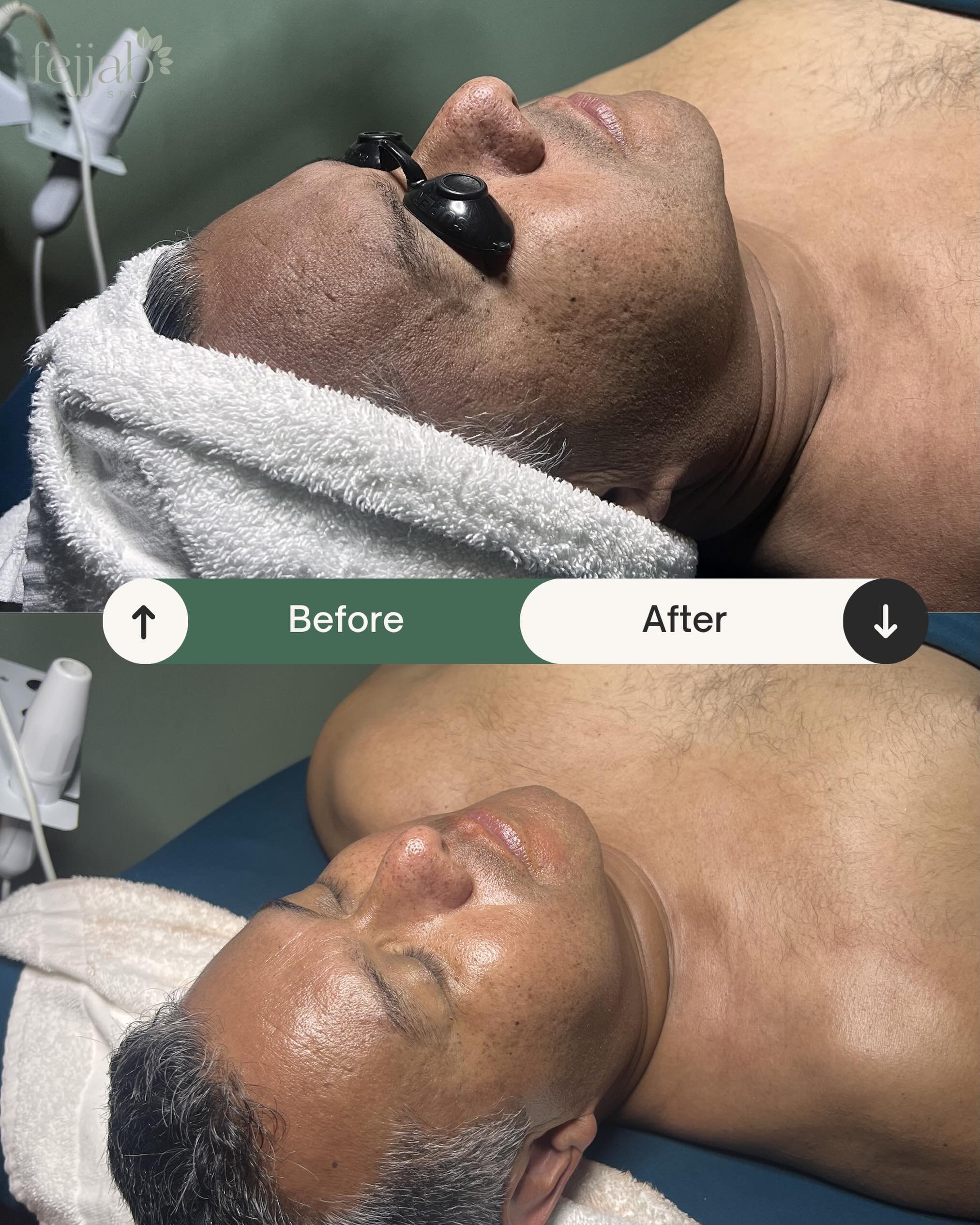 Dad&rsquo;s skin, refreshed. ✨

Our Father&rsquo;s Day Facial was designed to deeply cleanse, hydrate, and revitalize the skin&mdash;leaving it looking brighter, healthier, and more refreshed.

Just look at the difference: improved hydration, a clean