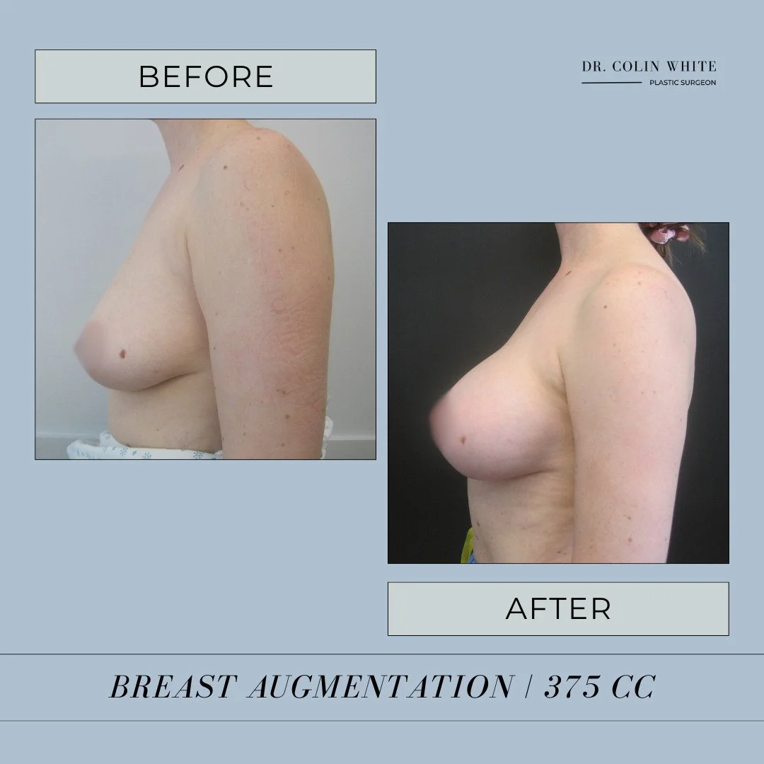 This patient&rsquo;s breast augmentation with 375cc implants resulted in a beautifully balanced and refined look. If you're considering anything from a natural boost to a fuller figure, we&rsquo;ll help you find the right implant size for your goals.