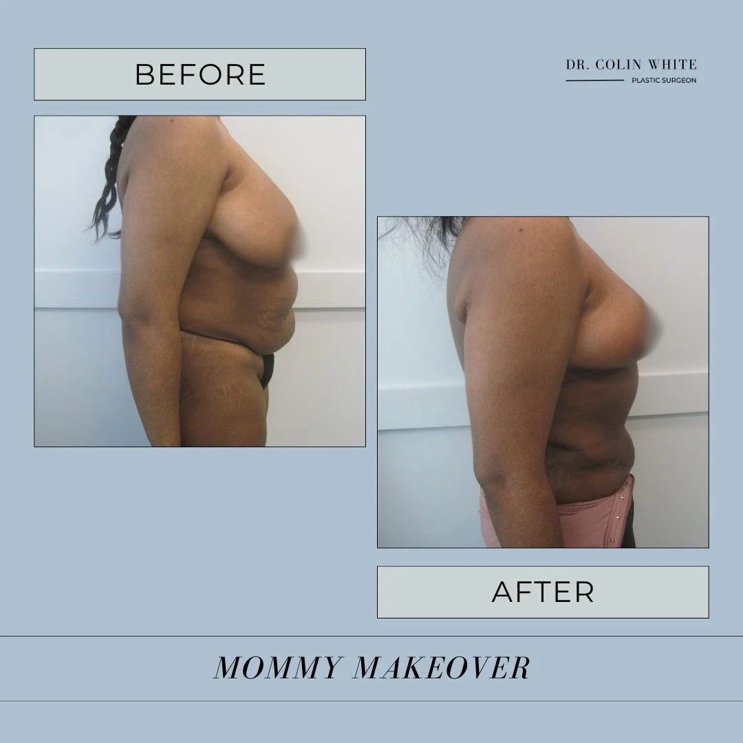 Our patient&rsquo;s Mommy Makeover results are truly remarkable! After a tummy tuck and breast lift, she&rsquo;s achieved a beautifully balanced, natural look 🌸⁠
⁠
If you&rsquo;re considering a similar transformation to restore your body after pregn