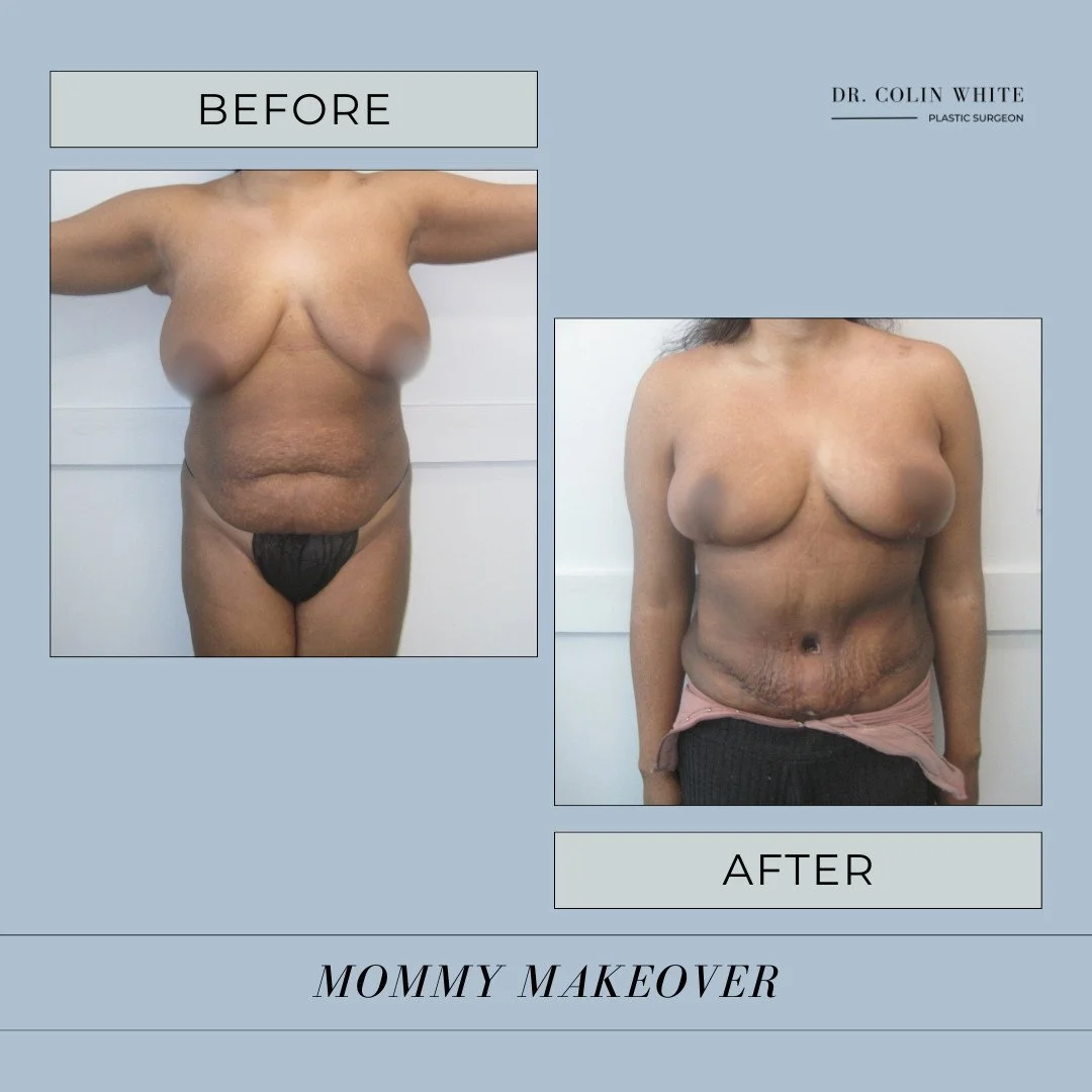 Our patient wanted to restore her figure after pregnancy with a Mommy Makeover. ✨ We started with a breast lift to improve symmetry and projection, then performed a tummy tuck to tighten and tone her abdomen, giving her a sleek, sculpted look. ⁠
⁠
If