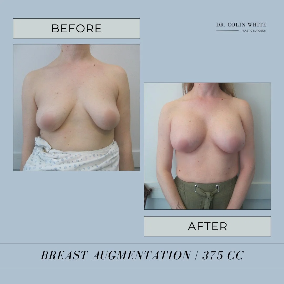 Did you know that 375cc implants can deliver a natural, lifted look? Our lovely patient wanted enhanced shape and symmetry, and her results are stunning! 🌟⁠
⁠
Curious if breast augmentation is right for you? Schedule a consultation and let&rsquo;s d