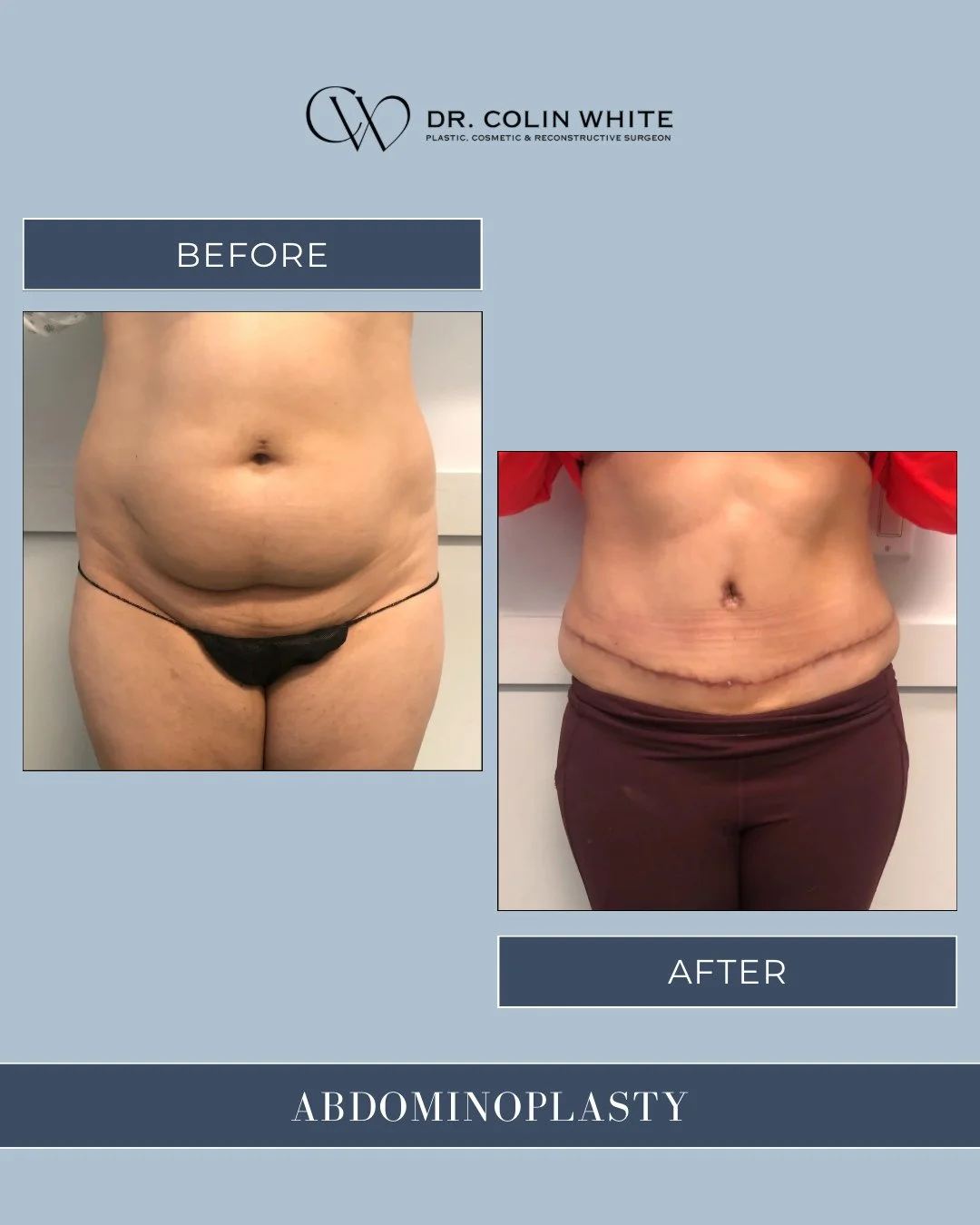 Transformation isn&rsquo;t just about appearance &mdash; it&rsquo;s about how you feel!⁠
⁠
This abdominoplasty result showcases the power of surgical precision and patient-centred care.⁠
⁠
From restoring muscle tone to refining silhouette, every step