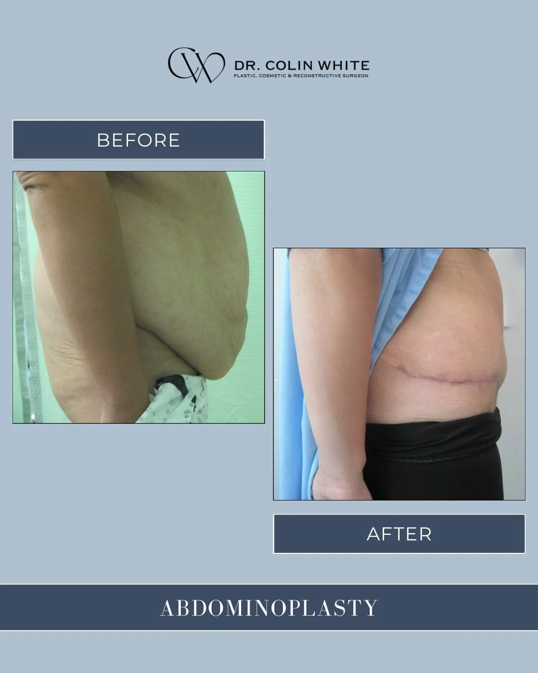 Profile refinement with purpose 🤩⁠
⁠
An abdominoplasty can address stretched skin and muscle separation, helping improve abdominal tone and posture ✔️⁠
⁠
This side view shows a naturally balanced contour achieved through precise, individualized plan