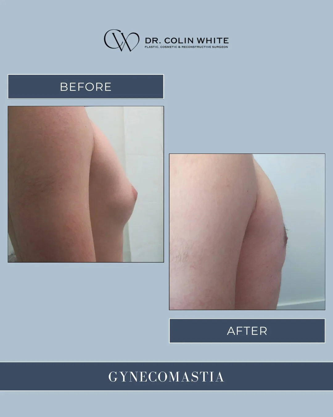 Gynecomastia &mdash; the development of excess chest tissue in men &mdash; is more common than most realize.⁠
⁠
It can affect confidence, posture, and even clothing choices.⁠
⁠
Through precise surgical treatment, it&rsquo;s possible to restore a flat