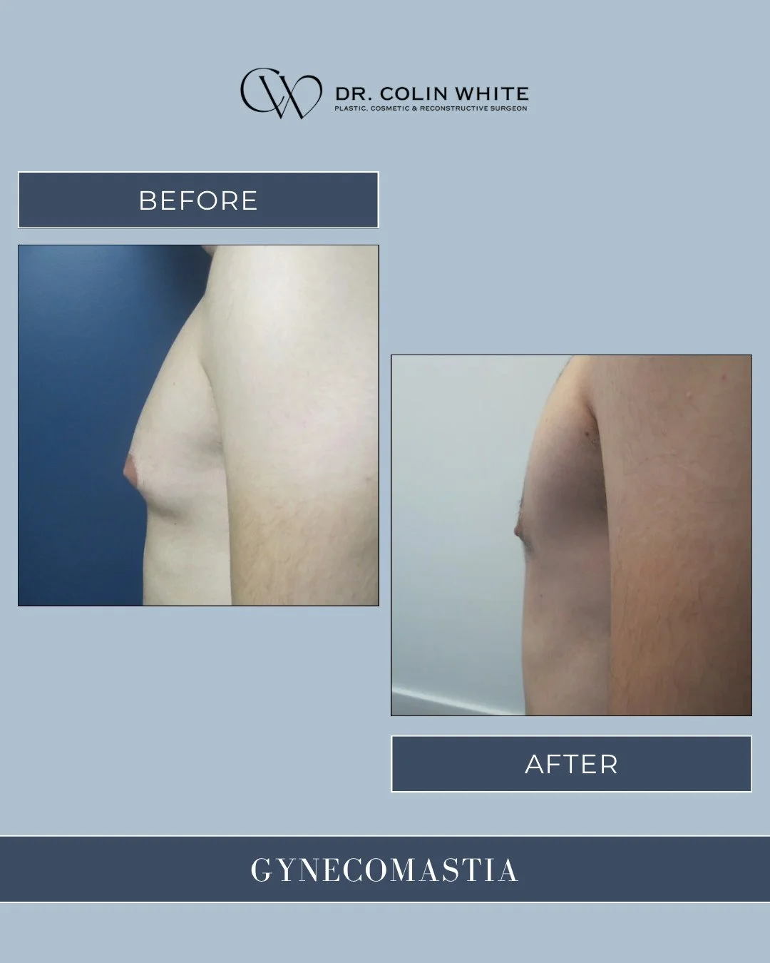 A closer look at gynecomastia surgery &mdash; tailored, precise, and patient-focused.⁠
⁠
Treatment for gynecomastia typically involves removing glandular tissue and/or fat through small incisions or liposuction, depending on the underlying cause.⁠
⁠
