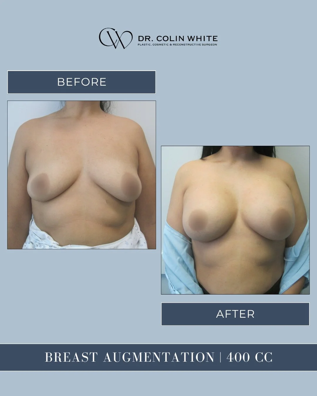 This 400cc breast augmentation highlights how individualized planning supports aligned aesthetic outcomes. Every patient receives a plan tailored to their own anatomy and goals.⁠
⁠
👨🏻&zwj;⚕️ Performed by Dr. Colin White, Board-Certified Plastic Sur