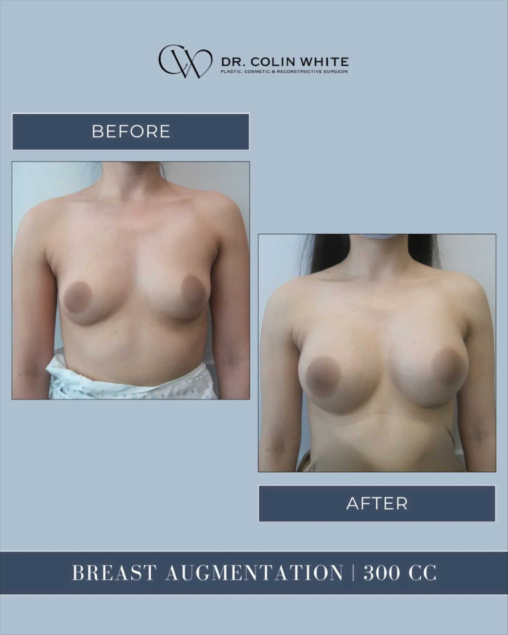 Natural-looking results start with customization.⁠
⁠
This 300cc breast augmentation was tailored to enhance proportion, symmetry, and confidence &mdash; without overpowering the frame.⁠
⁠
At Metrotown Surgical Centre, Dr. Colin White offers individua