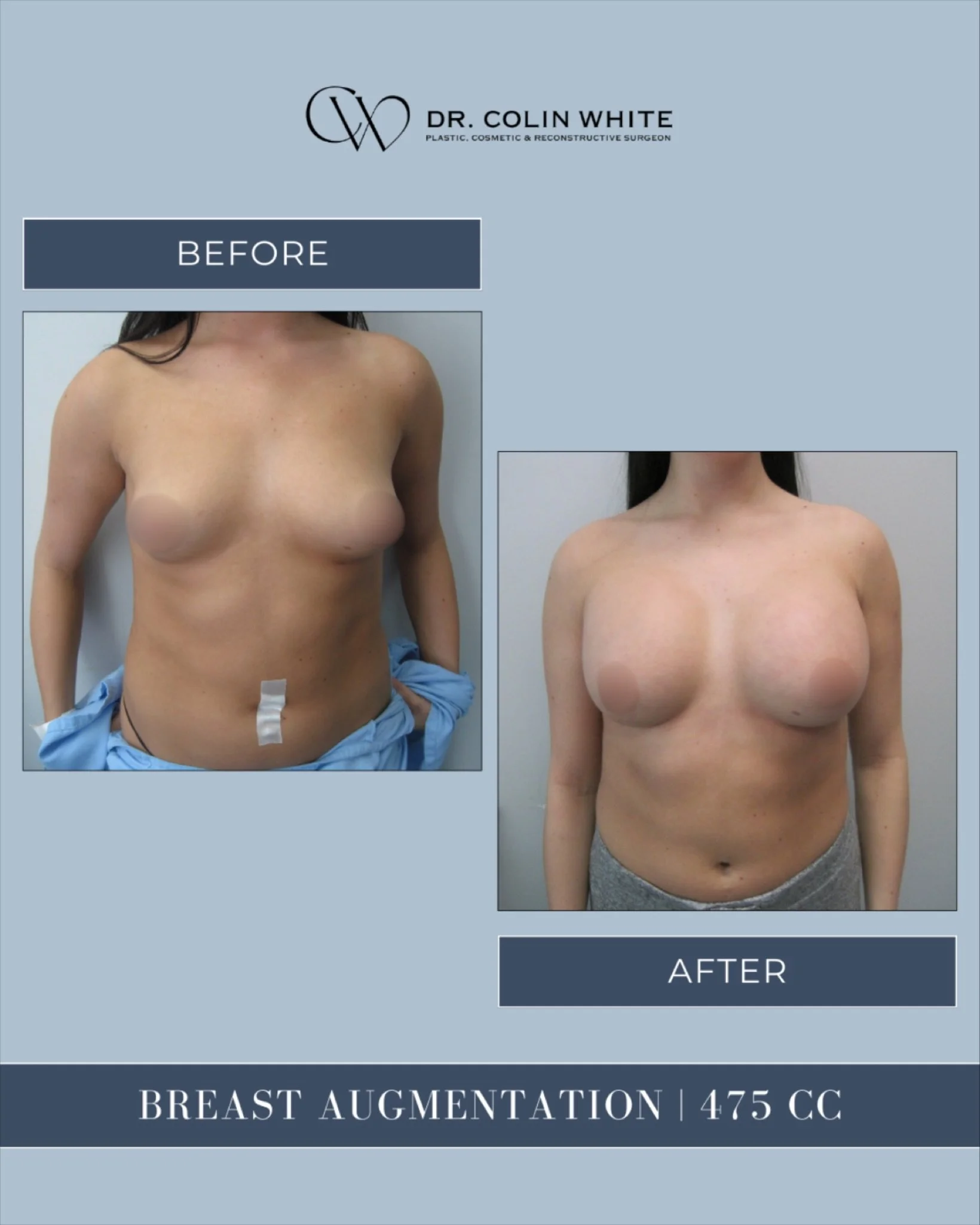 Breast augmentation is never one-size-fits-all.⁠
⁠
This 475cc case highlights how customized planning supports proportional and intentional results. Every patient&rsquo;s surgical plan is created based on their unique anatomy and goals discussed duri