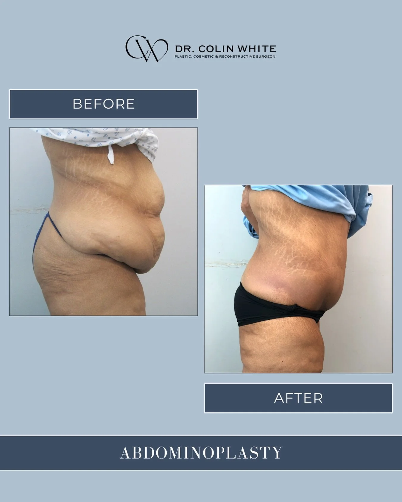 Abdominoplasty may be considered to address changes in the abdominal area, including skin laxity and muscle separation.⁠
⁠
This side profile illustrates how individualized surgical techniques are used to support balanced contour while prioritizing an