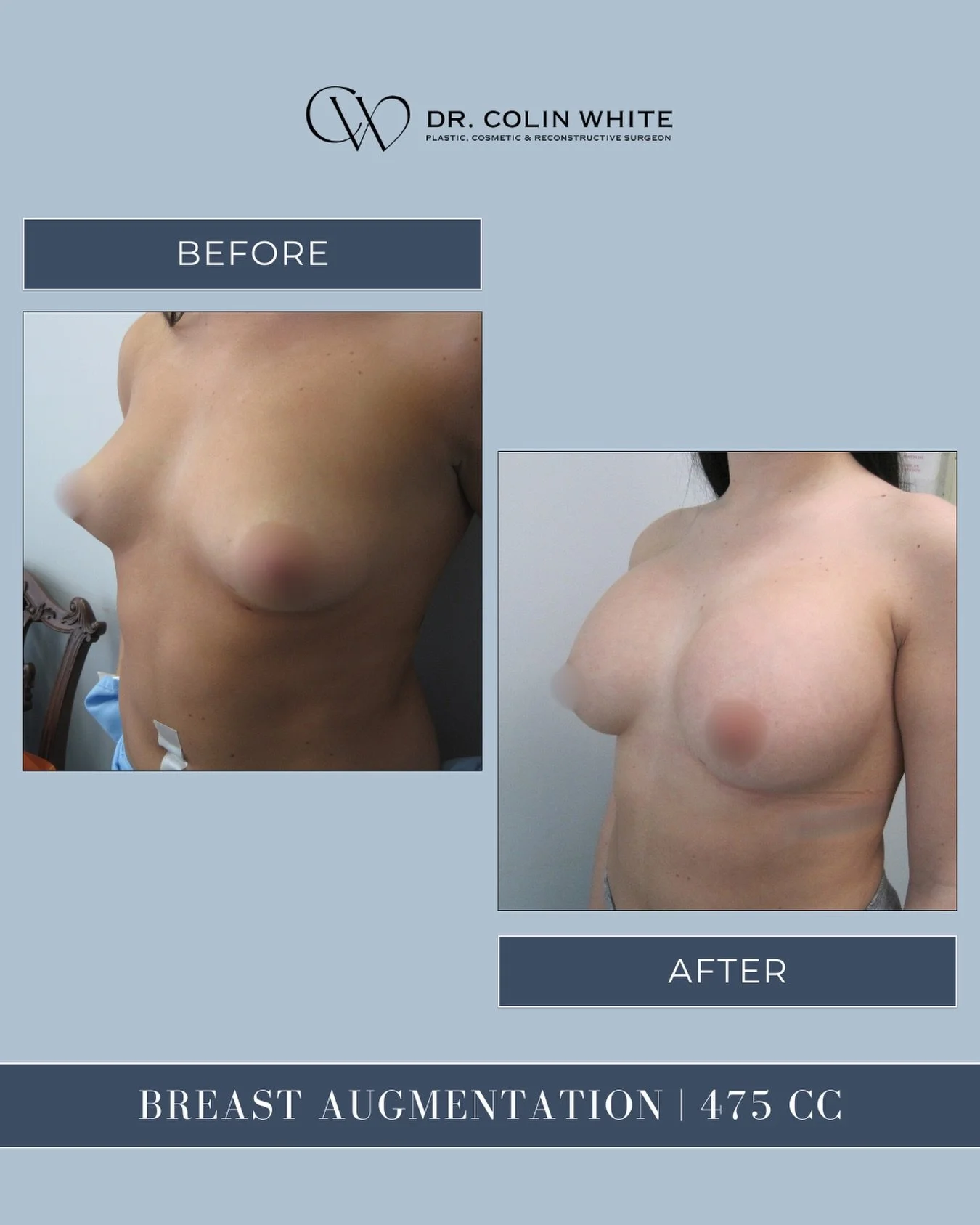 There is no &ldquo;standard&rdquo; implant size.⁠
⁠
This 475cc breast augmentation highlights how surgical planning considers body frame, tissue characteristics, and aesthetic preferences, not just numbers.⁠
⁠
During consultation, patients may discus