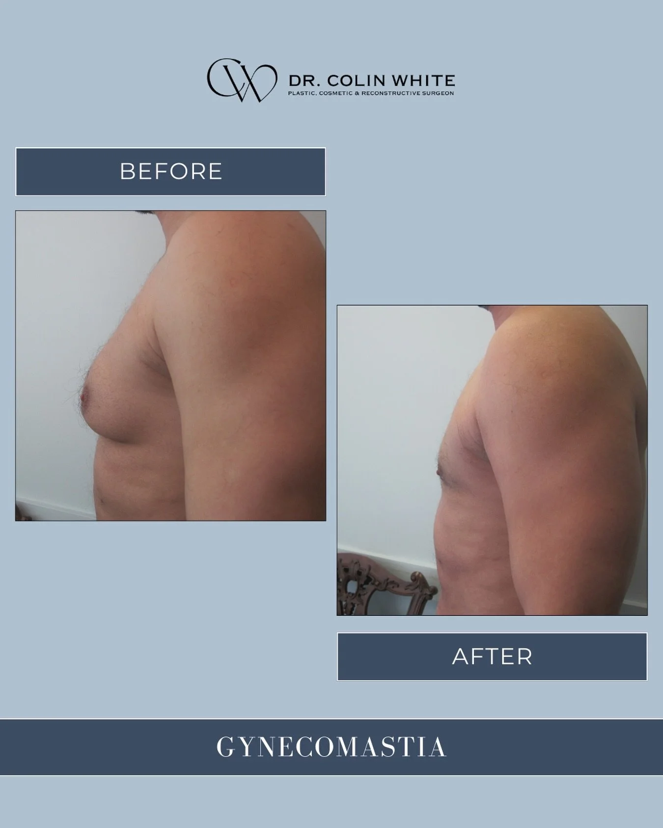 Gynecomastia can affect more than appearance, it can influence how men feel in their own bodies.⁠
⁠
When appropriate, surgical treatment may help address excess chest tissue and improve overall balance and comfort.⁠
⁠
Consultation is the first step t