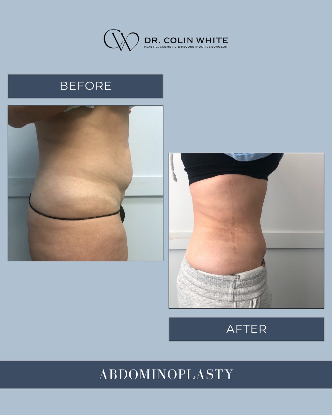 Changes to the abdominal area such as skin laxity or muscle separation &mdash;are common and unique to each individual.⁠
⁠
Abdominoplasty may be discussed as part of a personalized surgical plan focused on anatomy, proportion, and realistic outcomes.