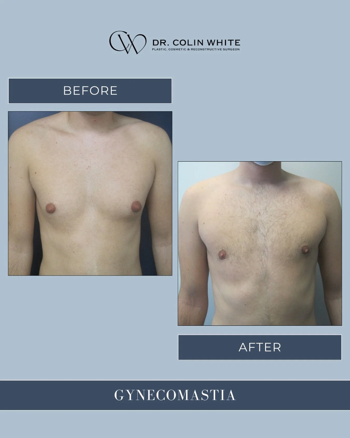 Gynecomastia is more common than you think.⁠
⁠
Many men experience excess chest tissue at some point in life. When appropriate, surgical treatment may be discussed to address contour and balance based on individual anatomy.⁠
⁠
Common questions we hea