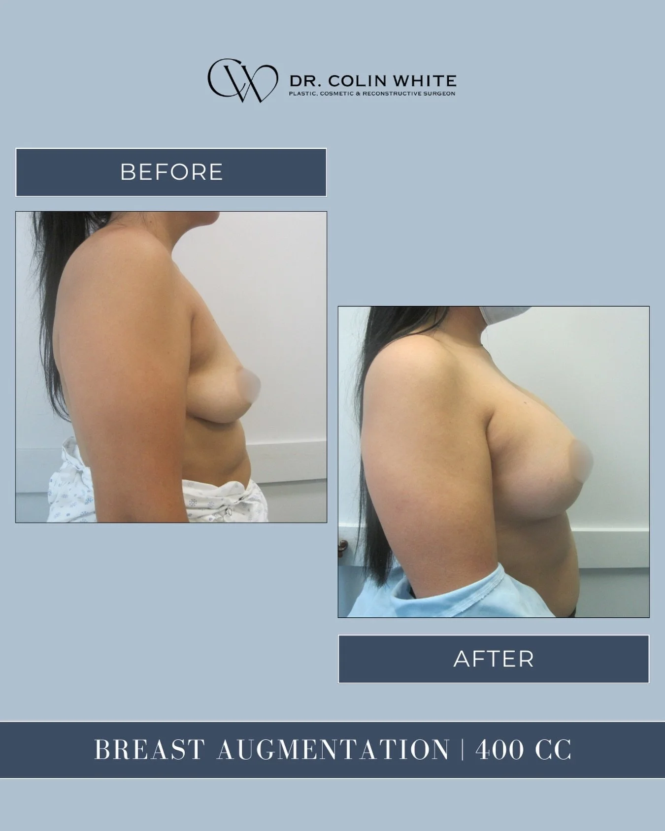 What does 400cc mean in breast augmentation?⁠
⁠
Implant size is measured in cubic centimeters (cc), but the right choice depends on more than a number. Factors like chest dimensions, existing tissue, and personal goals all play a role in surgical pla