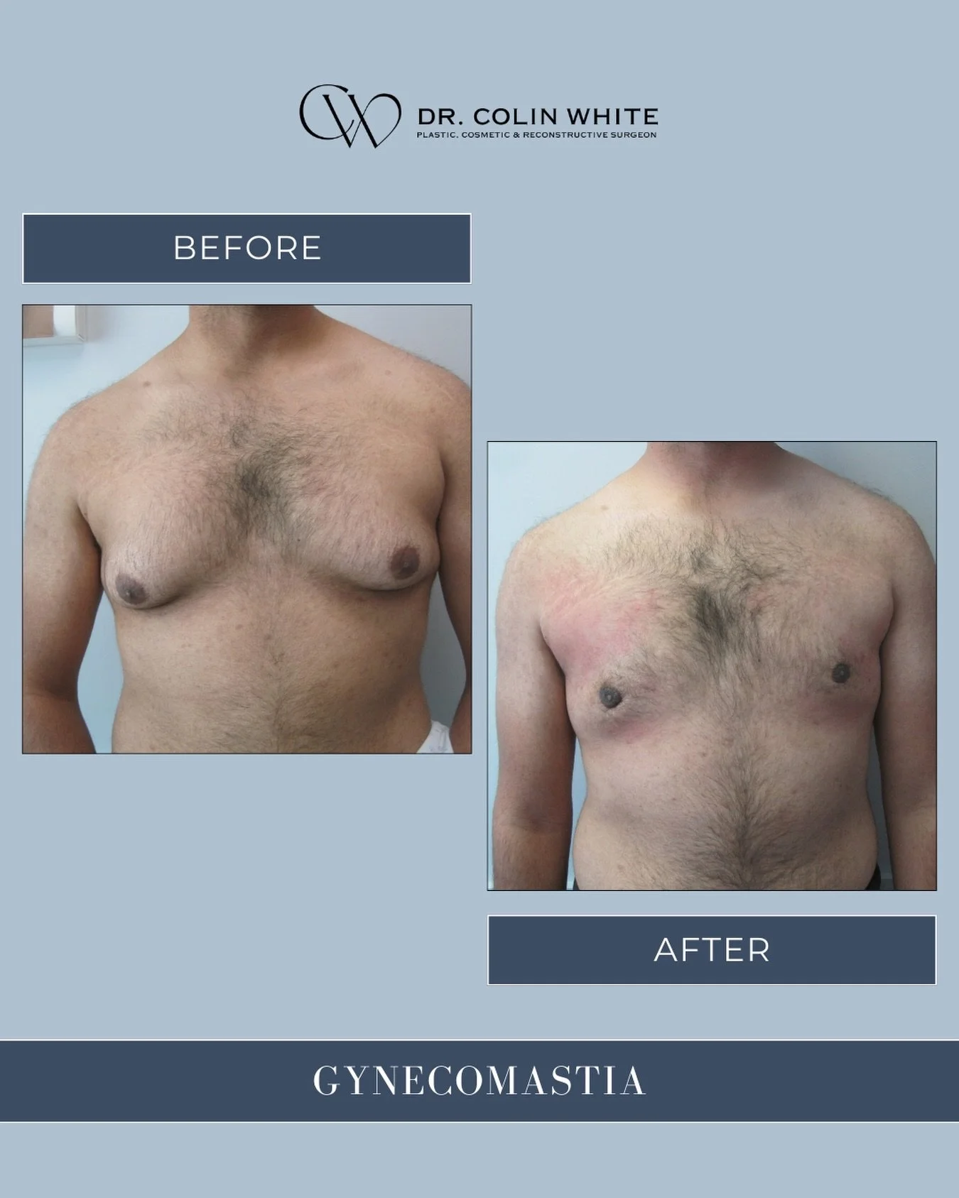 Struggling with stubborn chest tissue despite exercise?⁠
⁠
Gynecomastia is a common condition that can affect men at different stages of life. When excess tissue does not resolve naturally, surgical treatment may be an option to improve chest contour