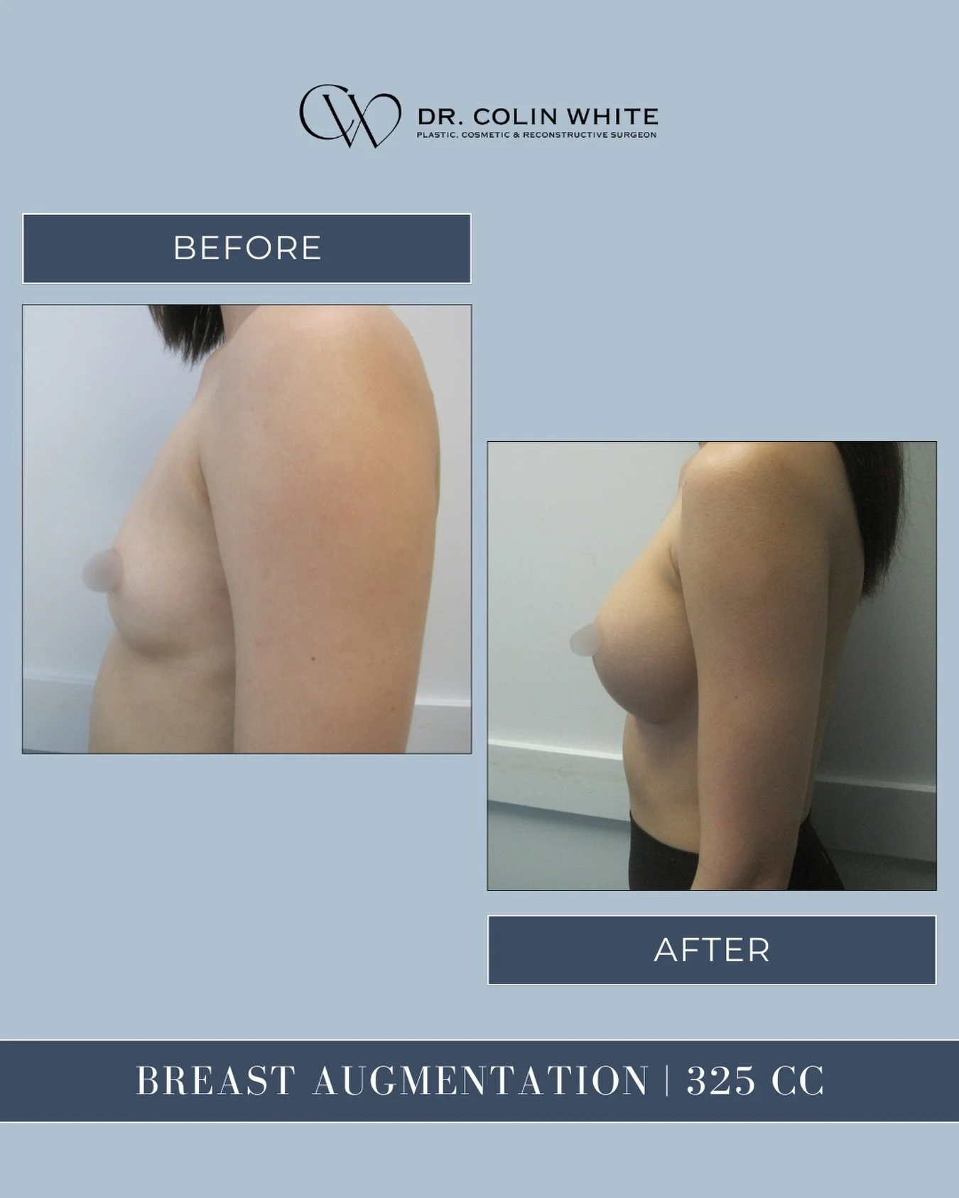 Customization matters.⁠
⁠
This 325cc breast augmentation was selected based on the patient&rsquo;s anatomy and goals to support balanced, individualized results 🙌🏻⁠
⁠
Book a consultation to learn more about your options with Dr. Colin White.⁠
⁠
📞 