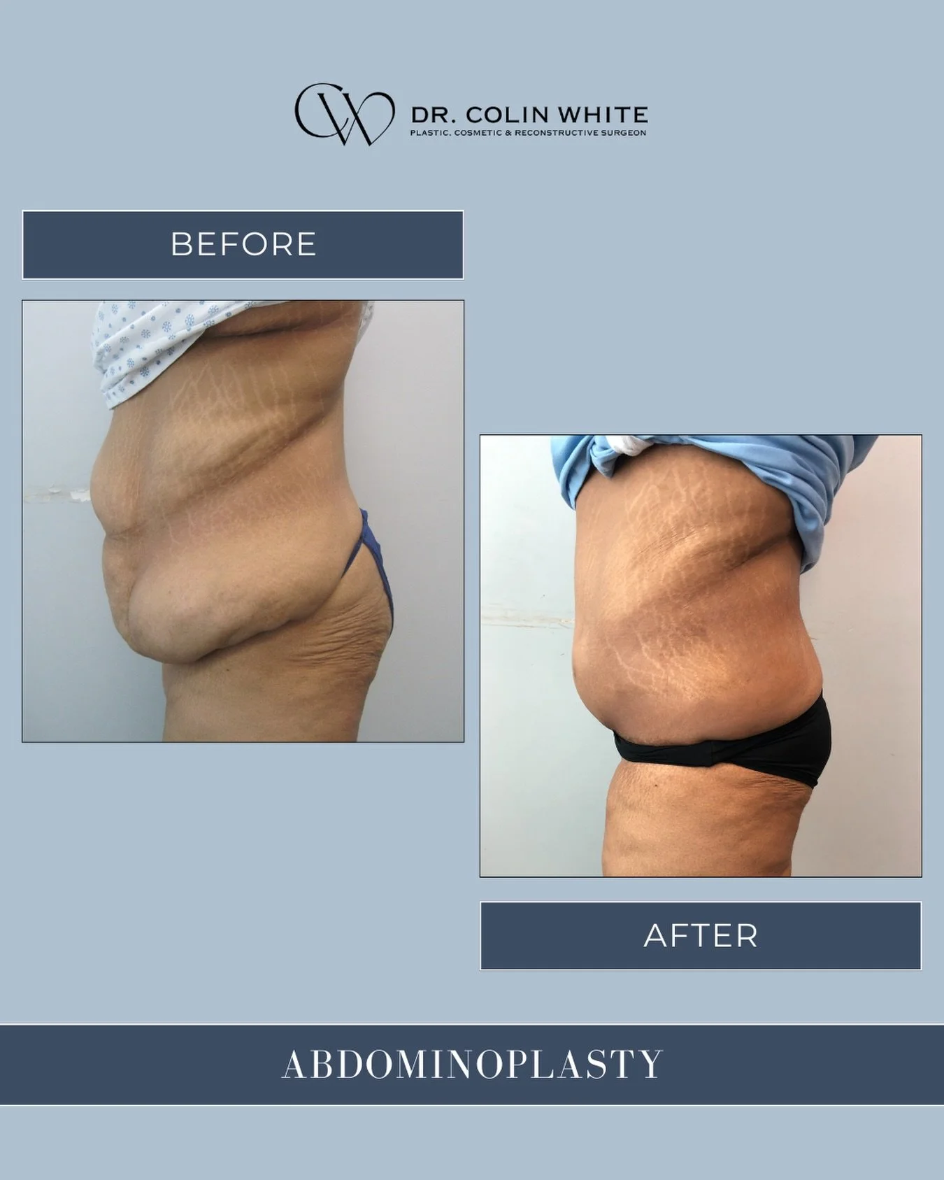 What does abdominoplasty look like from the side?⁠
⁠
Our patient&rsquo;s side profile highlights how abdominoplasty may address abdominal skin laxity and muscle separation through individualized surgical planning. Techniques are selected based on ana