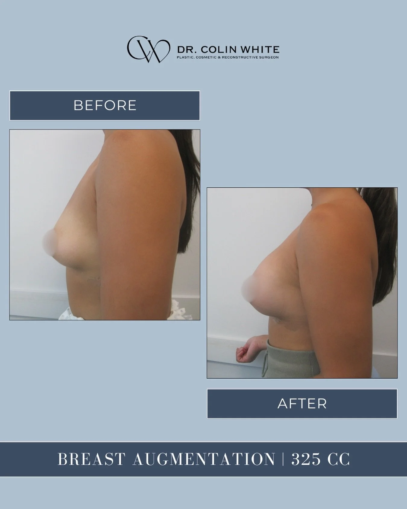 This 325cc breast augmentation highlights how individualized planning supports balance and proportion based on the patient&rsquo;s unique anatomy. ⁠
⁠
Surgical recommendations are tailored, and may include augmentation alone or in combination with ot