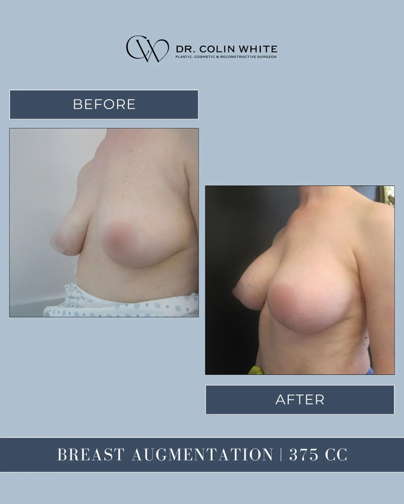 Considering breast augmentation? Here&rsquo;s what 375cc can look like 👀✨⁠
⁠
Every result is uniquely tailored, based on anatomy, goals, and surgical planning. Volume is just one part of the equation.⁠
⁠
In this case, a 375cc implant was selected to