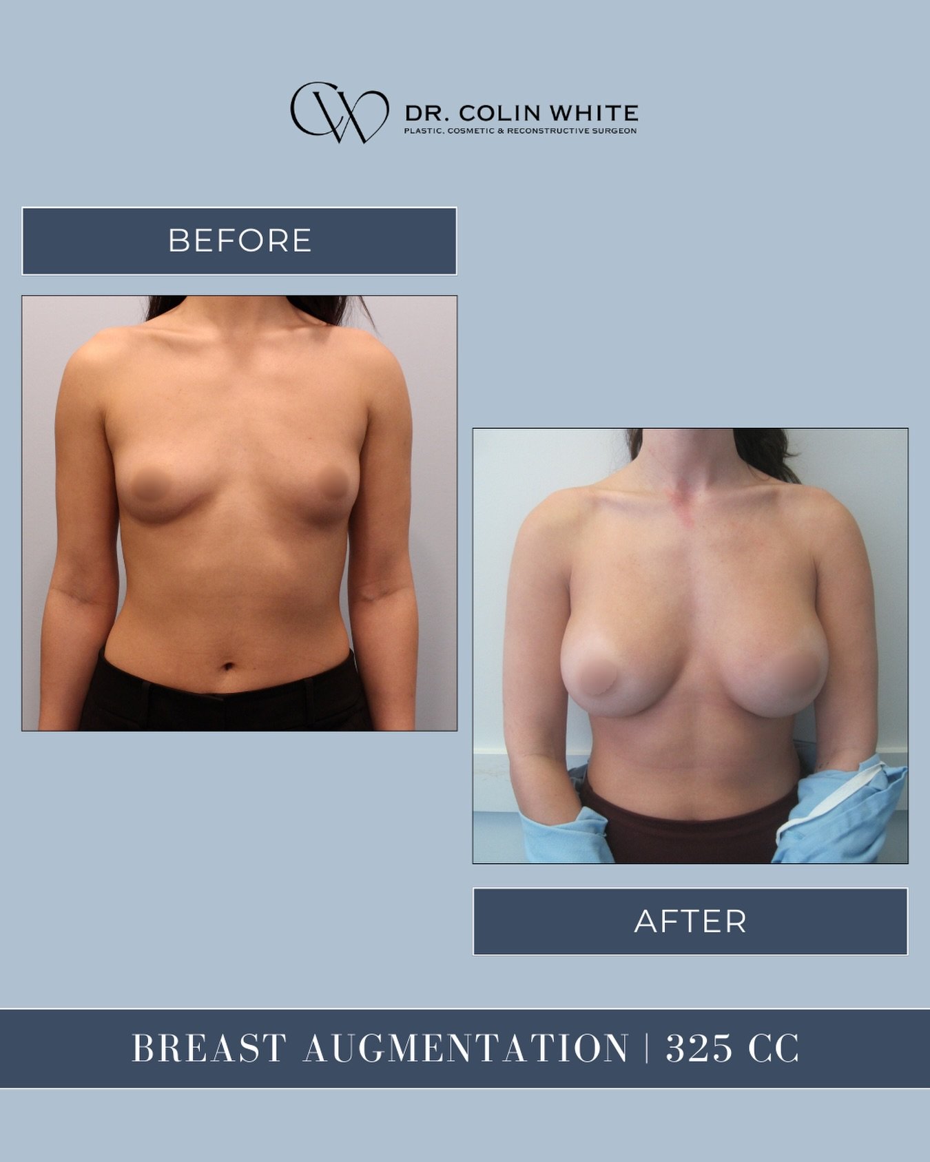 What does breast augmentation look like years later? 👀⁠
⁠
This case features 325cc implants, shown from a front view at 3.6 years post-procedure.⁠
⁠
While results evolve over time, thoughtful planning and technique aim to support long-lasting, natur