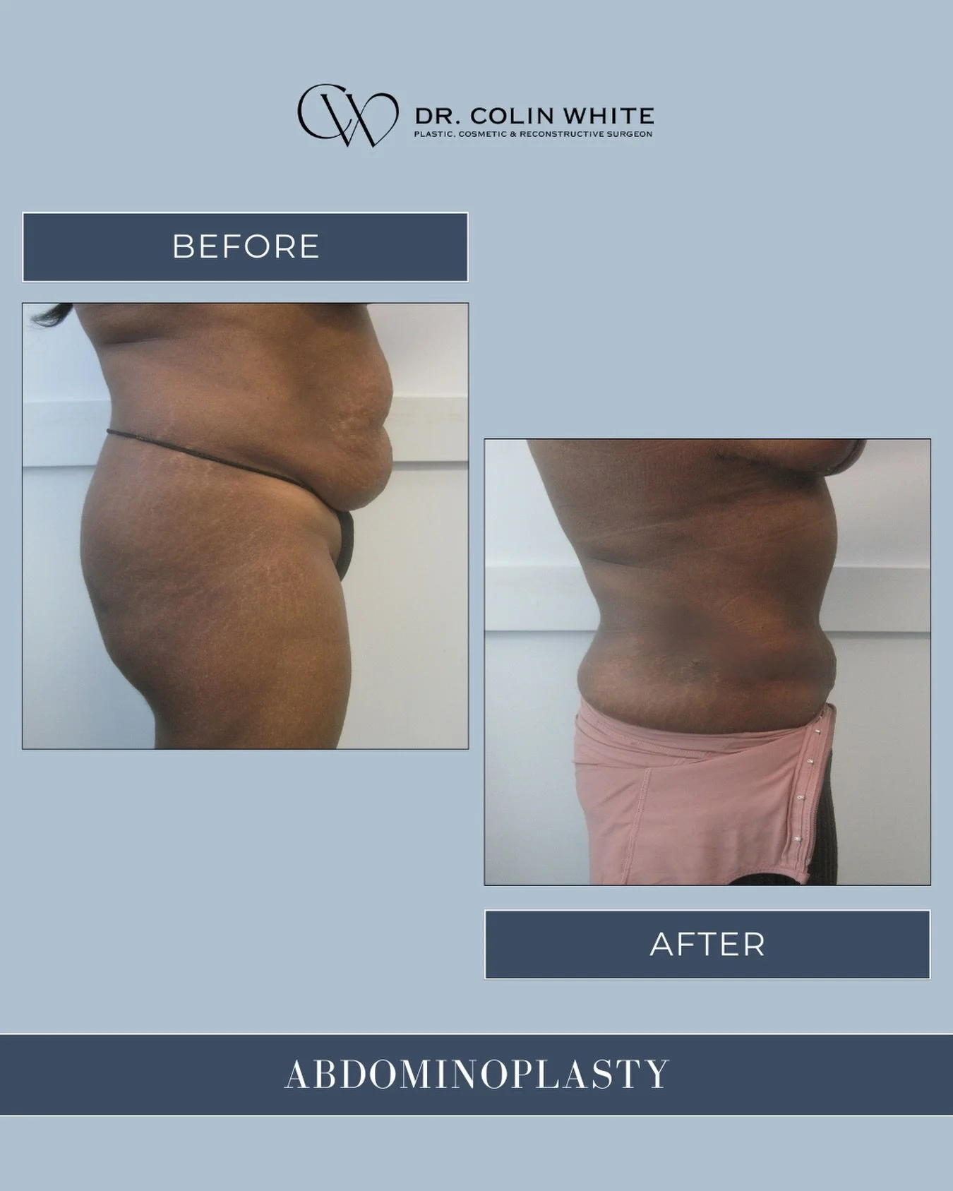 Abdominal changes after pregnancy or weight fluctuations are more common than you think 👀⁠
⁠
Skin laxity and muscle separation (diastasis recti) can vary from person to person.⁠
⁠
In this case, an abdominoplasty (tummy tuck) was performed as part of
