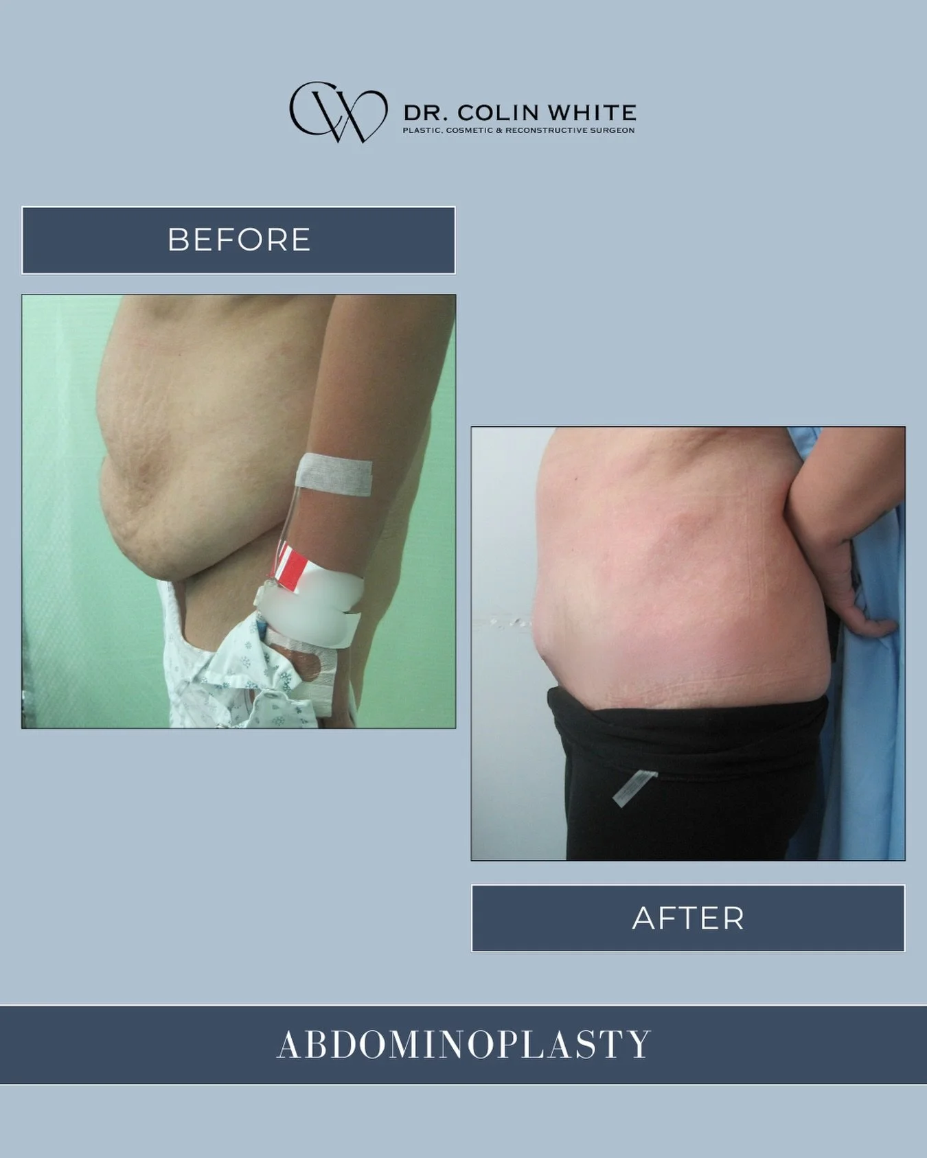 Every body changes and every treatment plan is unique.⁠
⁠
For some individuals, concerns like loose skin or muscle separation in the abdomen may be addressed through abdominoplasty.⁠
⁠
This side profile shows how results are shaped with careful plann