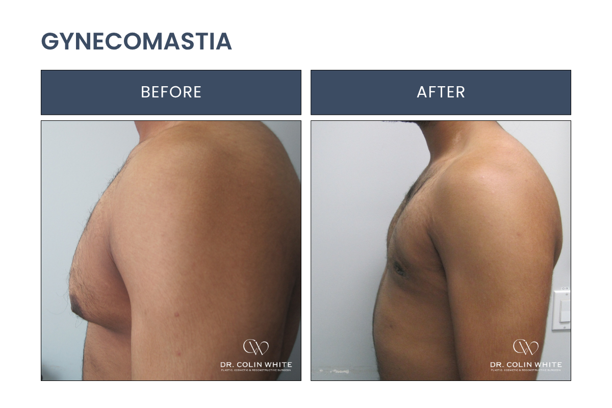 gynecomastia-mj-side.png